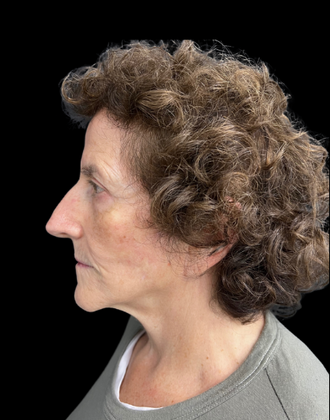 Blepharoplasty: Case 2 - After