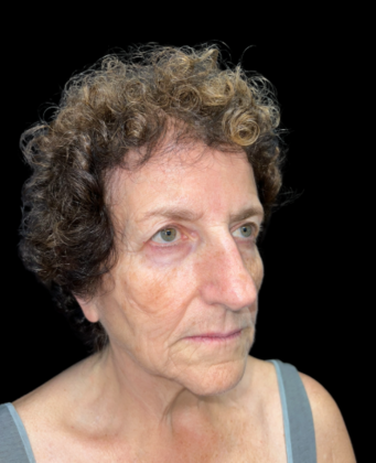 Blepharoplasty: Case 2 - Before