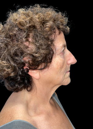 Blepharoplasty: Case 2 - Before