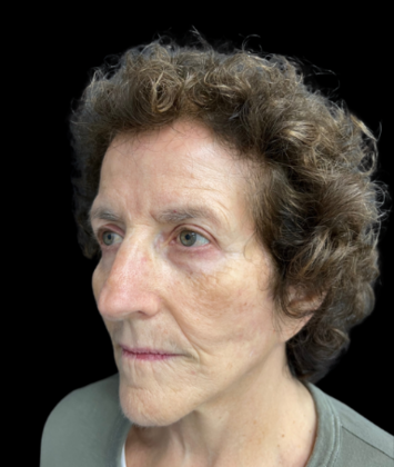 Blepharoplasty: Case 2 - After