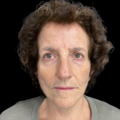 Blepharoplasty Case 2 - After