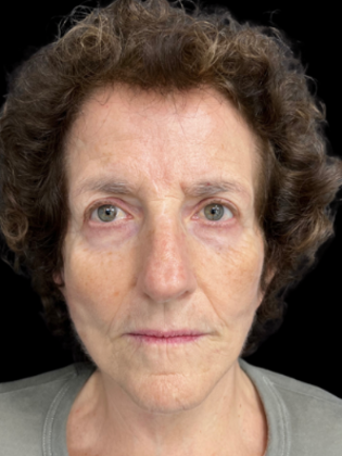 Blepharoplasty Blepharoplasty 2 - After
