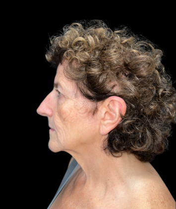 Blepharoplasty: Case 2 - Before