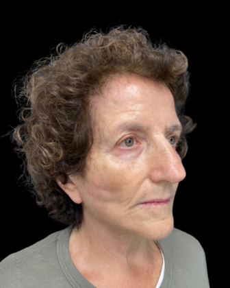 Blepharoplasty: Case 2 - After