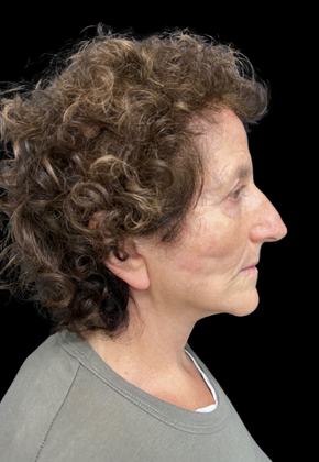 Blepharoplasty: Case 2 - After