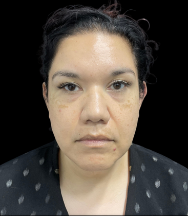 Chin Liposuction: Case 2 - Before