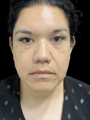 Chin Liposuction: Chin Liposuction 2 - Before