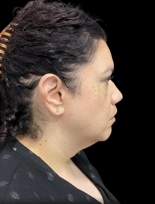 Chin Liposuction: Case 2 - Before