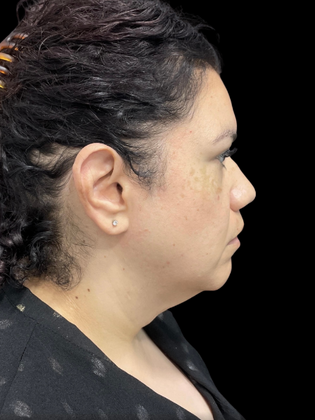 Chin Liposuction Chin Liposuction 2 - Before