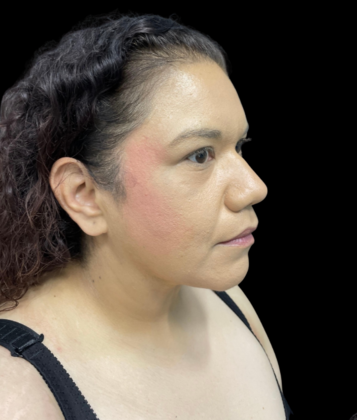 Chin Liposuction: Case 2 - After