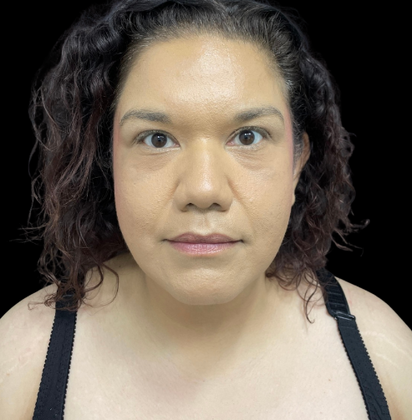 Chin Liposuction: Case 2 - After