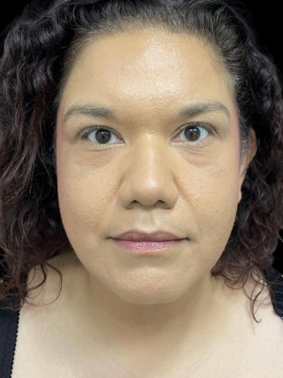 Chin Liposuction: Chin Liposuction 2 - After