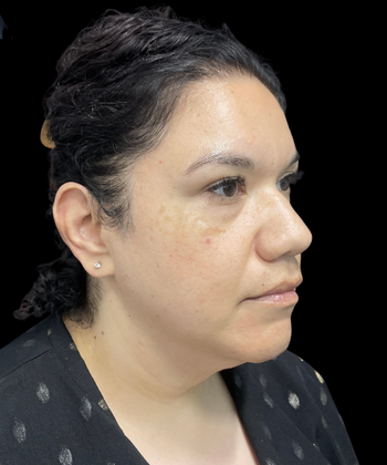 Chin Liposuction: Case 2 - Before
