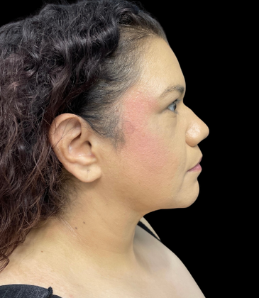 Chin Liposuction: Case 2 - After