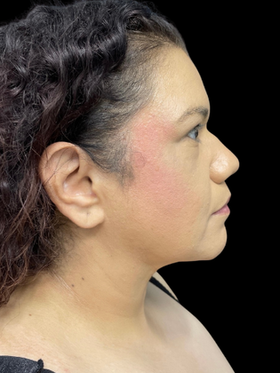 Chin Liposuction Chin Liposuction 2 - After