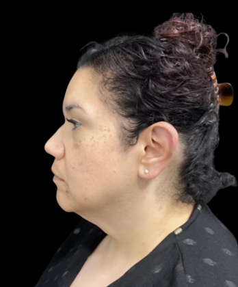 Chin Liposuction Case 2 - Before