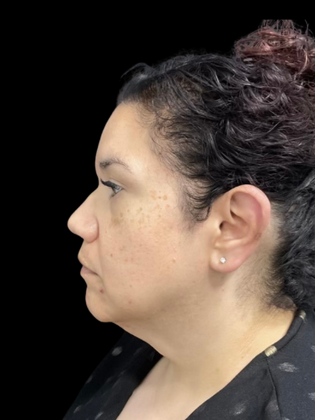 Chin Liposuction: Chin Liposuction 2 - Before