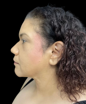 Chin Liposuction Case 2 - After