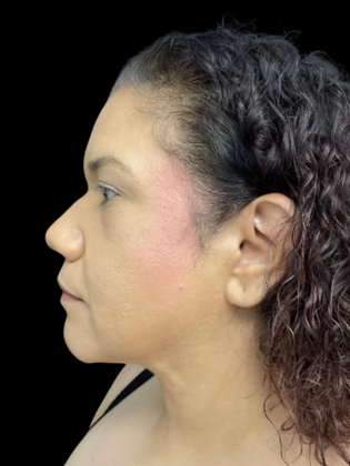 Chin Liposuction: Chin Liposuction 2 - After