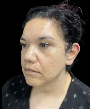 Chin Liposuction: Case 2 - Before