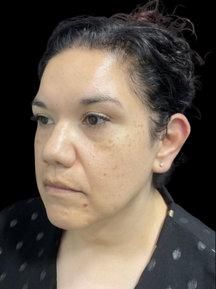 Chin Liposuction: Chin Liposuction 2 - Before