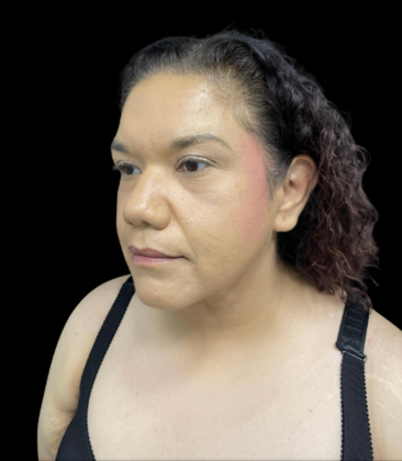 Chin Liposuction: Case 2 - After