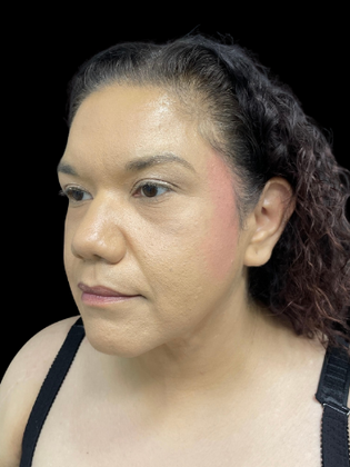 Chin Liposuction: Chin Liposuction 2 - After