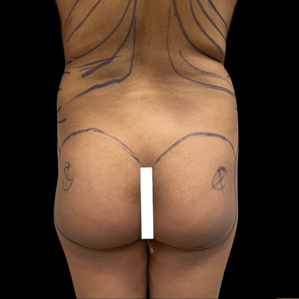 Brazilian Butt Lift Case 11 - Before