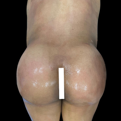 Brazilian Butt Lift Case 11 - After