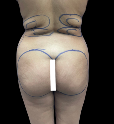 Brazilian Butt Lift Case 12 - Before