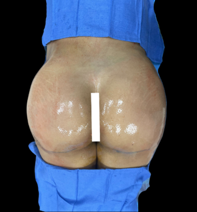 Brazilian Butt Lift Case 12 - After