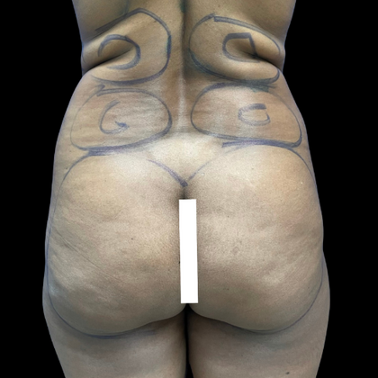 Brazilian Butt Lift Case 13 - Before