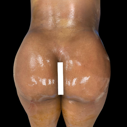 Brazilian Butt Lift Case 13 - After