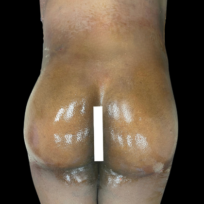Brazilian Butt Lift Case 14 - After