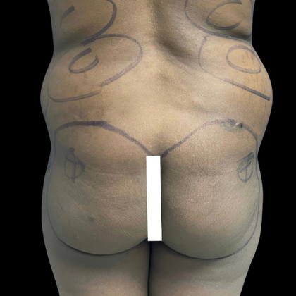 Brazilian Butt Lift Case 14 - Before