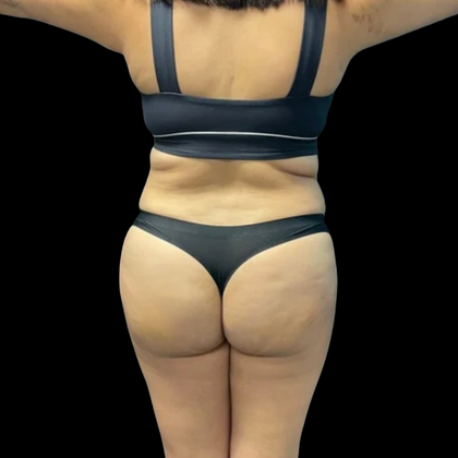 Brazilian Butt Lift Case 15 - After