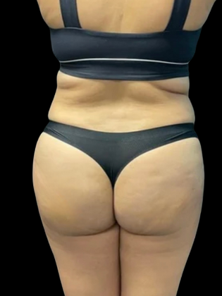 Brazilian Butt Lift BBL 9 - After