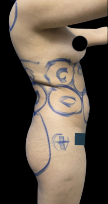 Brazilian Butt Lift: Case 16 - Before