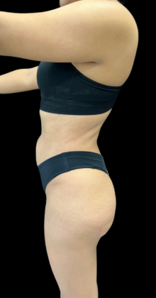 Brazilian Butt Lift: Case 16 - After