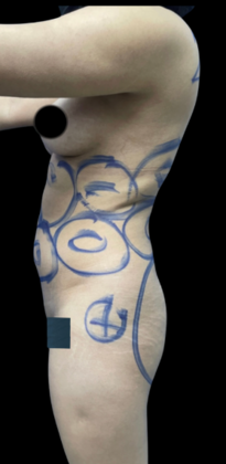 Brazilian Butt Lift: Case 16 - Before