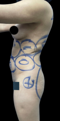 Brazilian Butt Lift: Case 16 - Before