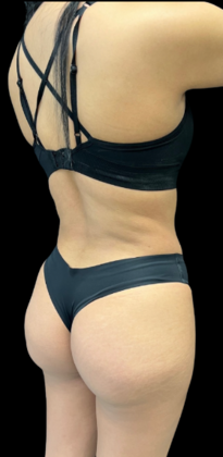 Brazilian Butt Lift: Case 16 - After