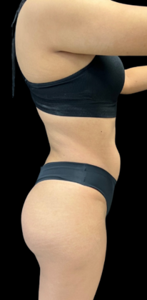 Brazilian Butt Lift: Case 16 - After