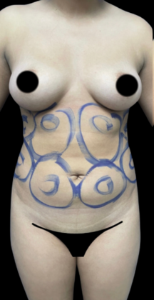 Brazilian Butt Lift: Case 16 - Before