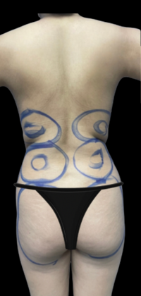 Brazilian Butt Lift Case 16 - Before