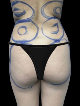 Brazilian Butt Lift BBL 10 - Before