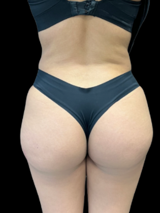 Brazilian Butt Lift BBL 10 - After