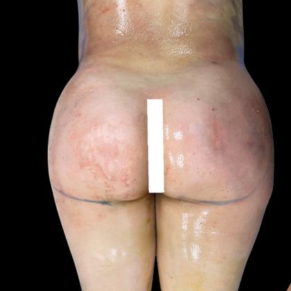 Brazilian Butt Lift Case 17 - After