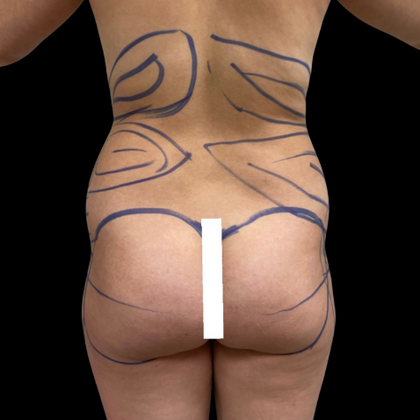 Brazilian Butt Lift Case 17 - Before