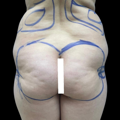 Brazilian Butt Lift Case 18 - Before